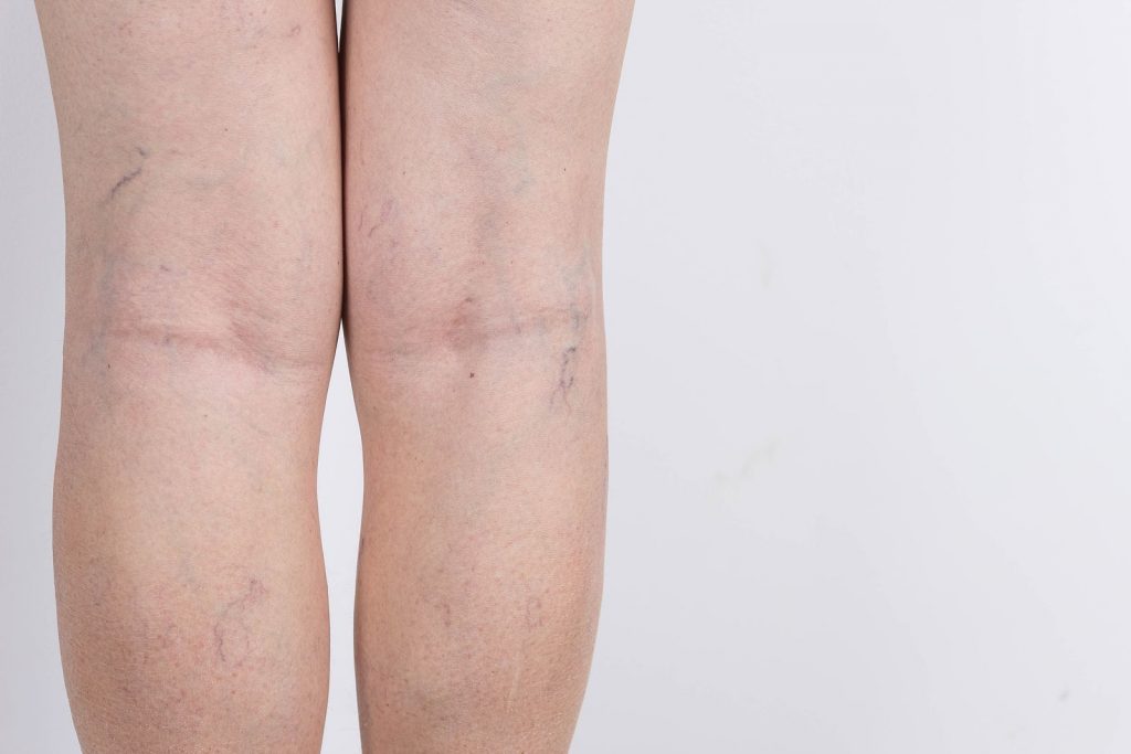 como reducir las venas varicosas